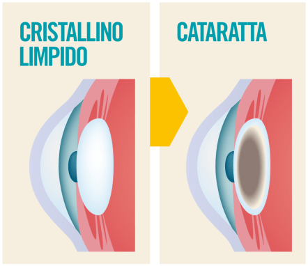 cristallino limpido e cataratta