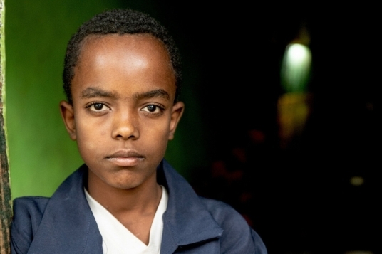 primo piano bambino con cataratta