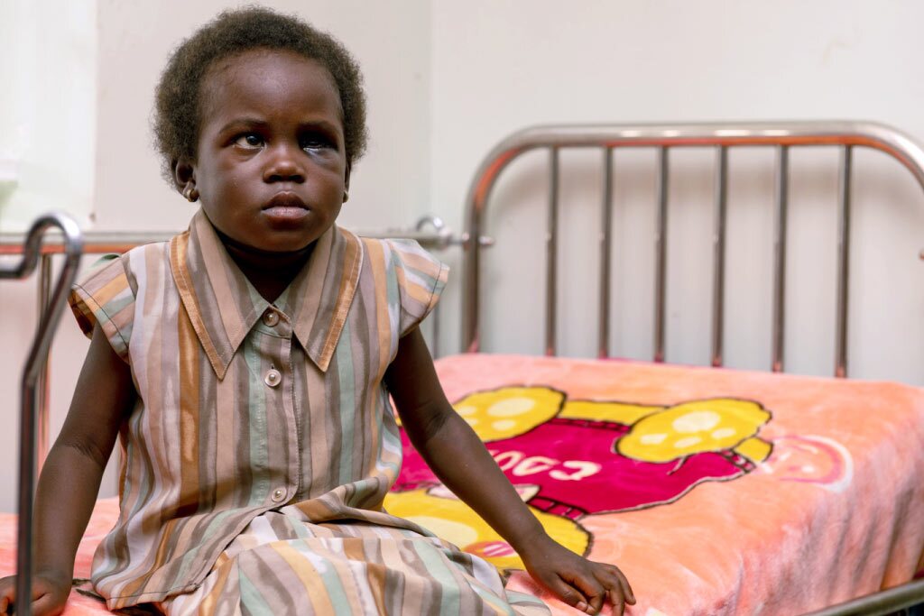 primo piano di Ruth con tumore all'occhio