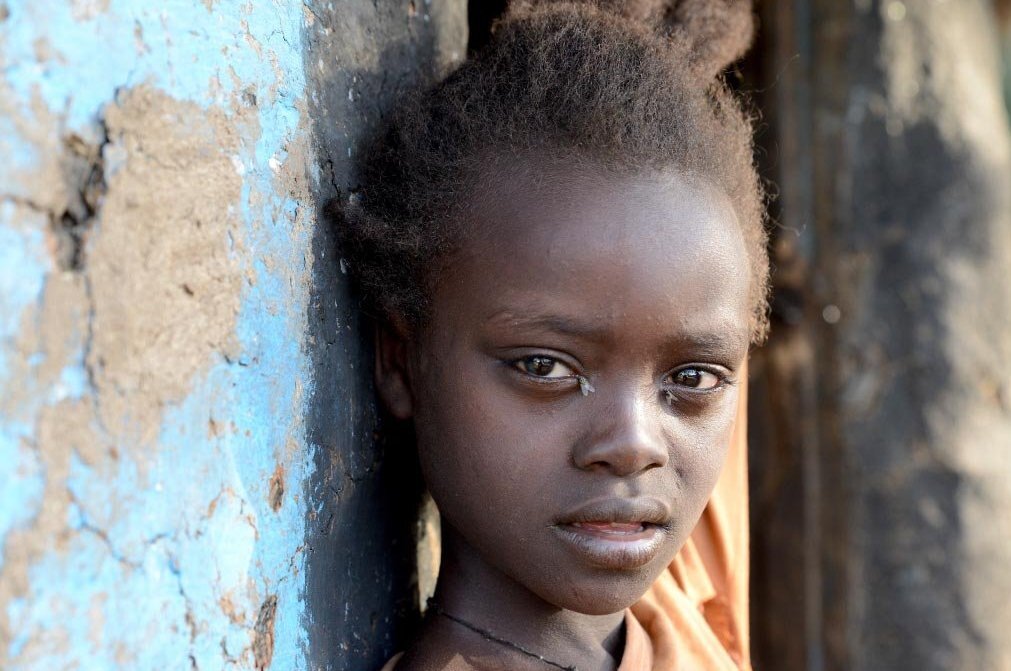 primo piano bambina con tracoma