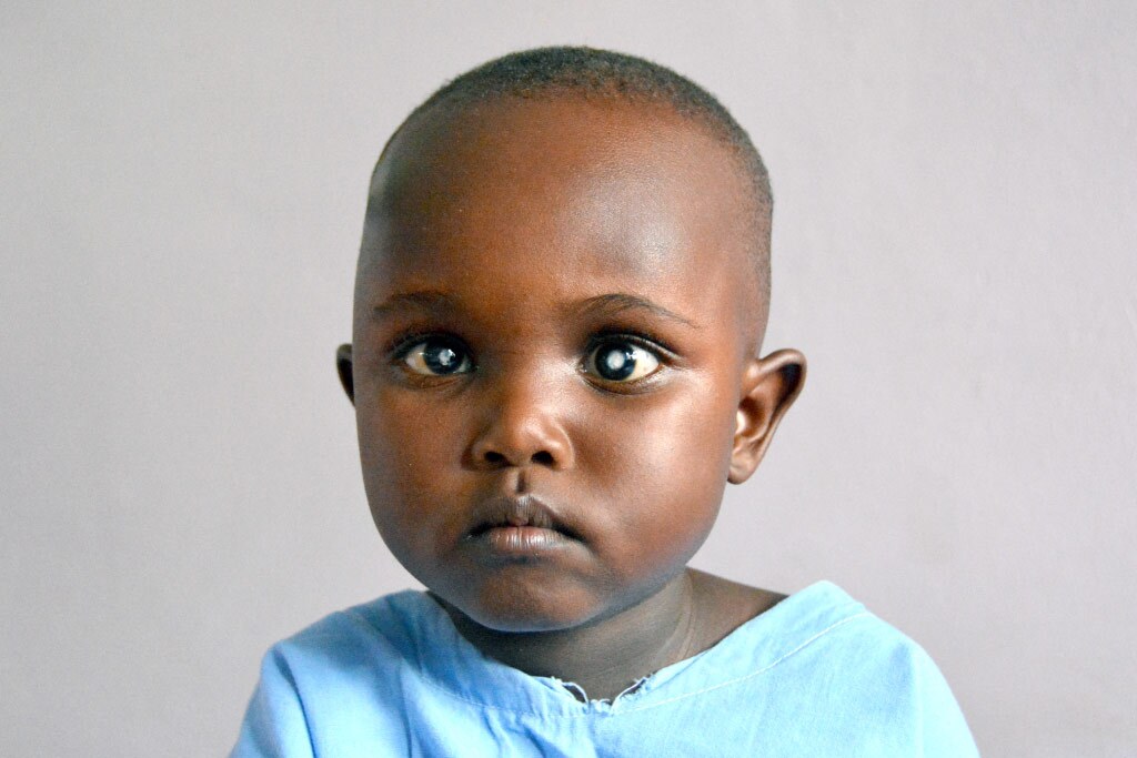 foto bimba con cataratta